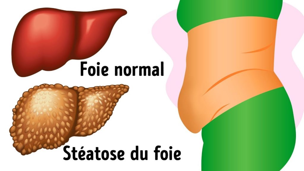 Voici les 10 choses à savoir sur la maladie du foie gras humain ...